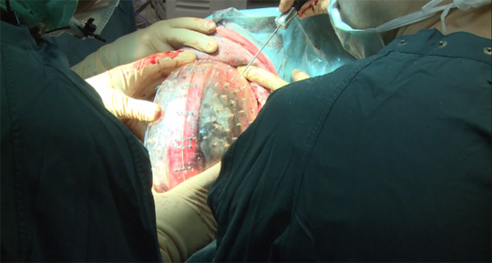 3D-Printed Skull Implanted into Woman's Head